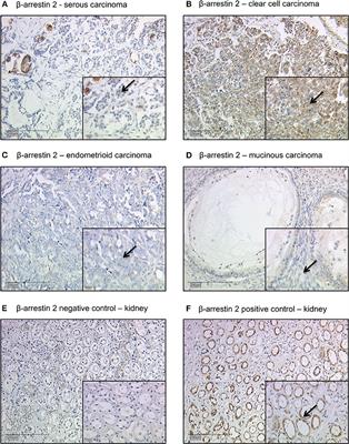 β-arrestin 2 Is a Prognostic Factor for Survival of Ovarian Cancer Patients Upregulating Cell Proliferation